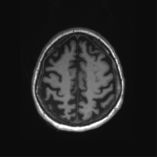 File:Behavioral variant frontotemporal dementia and late onset schizophrenia (Radiopaedia 52197-58083 Axial T1 15).png