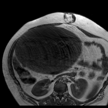 File:Benign seromucinous cystadenoma of the ovary (Radiopaedia 71065-81300 Axial T1 30).jpg