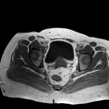 File:Benign seromucinous cystadenoma of the ovary (Radiopaedia 71065-81300 Axial T1 6).jpg