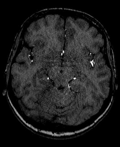 Berry aneurysm of the terminal internal carotid artery (Radiopaedia 88286-104918 Axial TOF 108).jpg