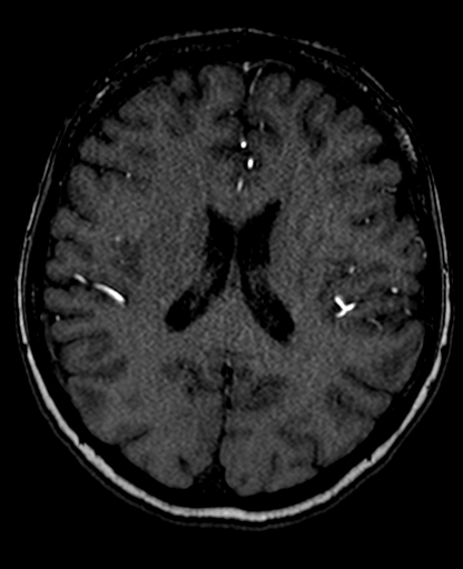 Berry aneurysm of the terminal internal carotid artery (Radiopaedia 88286-104918 Axial TOF 147).jpg
