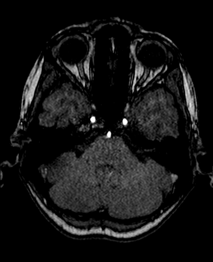 File:Berry aneurysm of the terminal internal carotid artery (Radiopaedia 88286-104918 Axial TOF 75).jpg