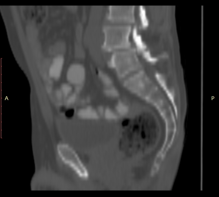 Bertolotti syndrome (Radiopaedia 58974-66235 Sagittal bone window 22).jpg