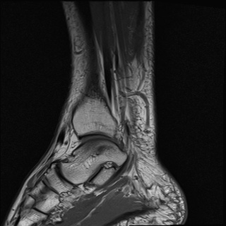 File:Bilateral Achilles tendon complete tear (Radiopaedia 81344-95051 Sagittal T1 13).jpg