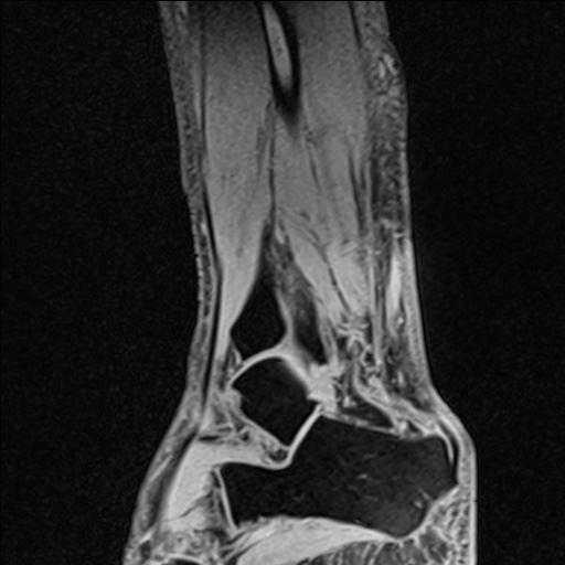 Bilateral Achilles tendon complete tear (Radiopaedia 81344-95051 Sagittal WE - Right 35).jpg