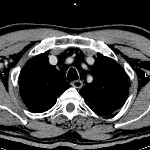 Bilateral Warthin tumors (Radiopaedia 84034-99263 Axial With contrast 71).jpg