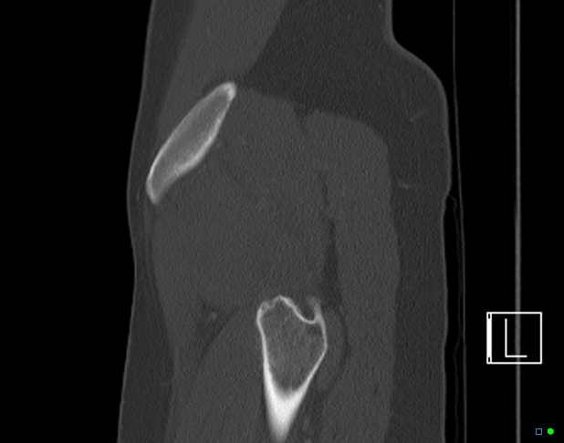 Bilateral acetabular fractures (Radiopaedia 79272-92308 Sagittal bone window 81).jpg