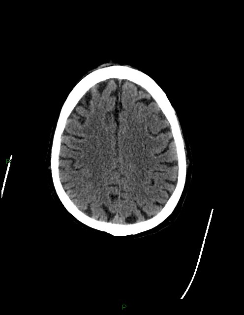 Bilateral acute middle cerebral artery territory infarcts (Radiopaedia 77319-89401 Axial non-contrast 64).jpg