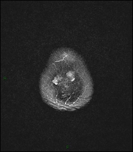 File:Bilateral acute middle cerebral artery territory infarcts (Radiopaedia 77319-89402 Axial FLAIR 24).jpg