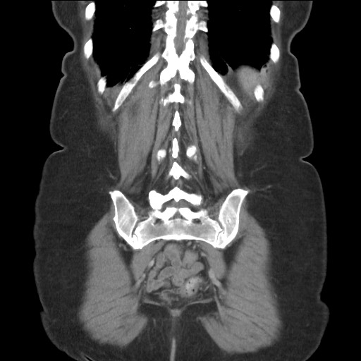 Bilateral adrenal granulocytic sarcomas (chloromas) (Radiopaedia 78375-91007 B 76).jpg