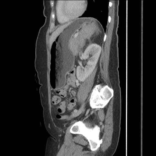 Bilateral adrenal granulocytic sarcomas (chloromas) (Radiopaedia 78375-91007 C 94).jpg