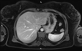 Bilateral adrenal myelolipoma (Radiopaedia 63058-71537 G 21).jpg