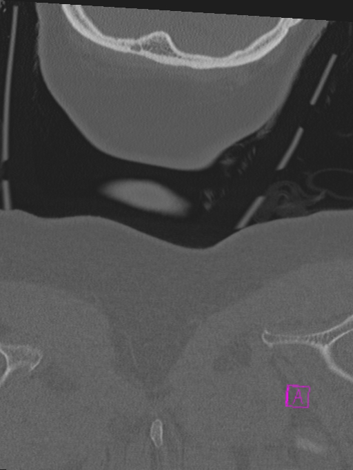 Bilateral atlanto-occipital assimilation (Radiopaedia 28350-28603 Coronal bone window 61).jpg