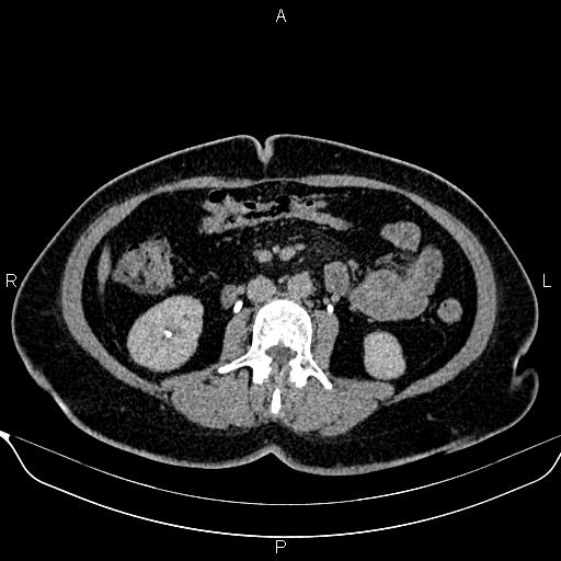 Bilateral benign adrenal adenomas (Radiopaedia 86912-103124 Axial C+ delayed 76).jpg