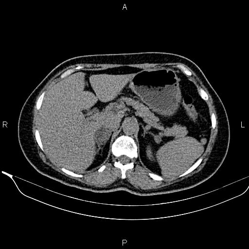 Bilateral benign adrenal adenomas (Radiopaedia 86912-103124 Axial non-contrast 33).jpg