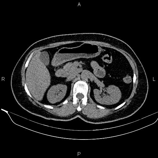 Bilateral benign adrenal adenomas (Radiopaedia 86912-103124 Axial non-contrast 43).jpg