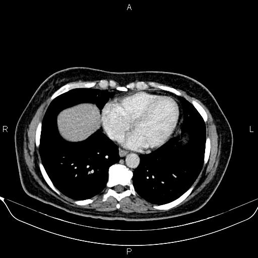 Bilateral benign adrenal adenomas (Radiopaedia 86912-103124 B 9).jpg
