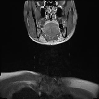 File:Bilateral carotid body tumors and right jugular paraganglioma (Radiopaedia 20024-20060 None 13).jpg