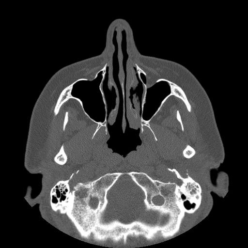 File:Bilateral ectopic infraorbital nerves (Radiopaedia 49006-54084 Axial 10).jpg