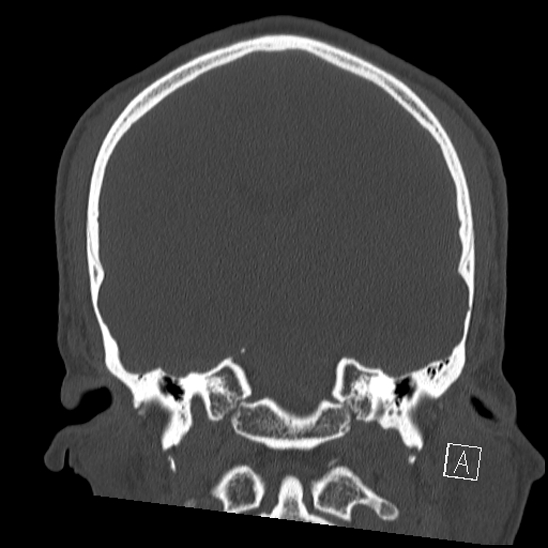 Bilateral occipital condyle fracture (type 2) (Radiopaedia 87675-104089 Coronal bone window 71).jpg