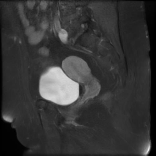 File:Bilateral ovarian dermoid cysts (Radiopaedia 90152-107338 Sagittal T1 C+ 16).jpg