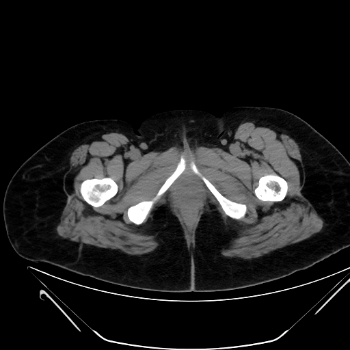 Bilateral ovarian mature cystic teratomas (Radiopaedia 79373-92457 Axial non-contrast 102).jpg