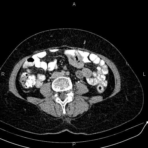 File:Bilateral ovarian serous cystadenocarcinoma (Radiopaedia 86062-101989 Axial C+ delayed 43).jpg