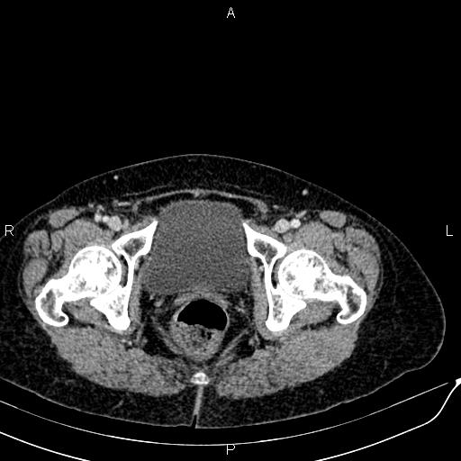 Bilateral ovarian serous cystadenocarcinoma (Radiopaedia 86062-101989 B 99).jpg