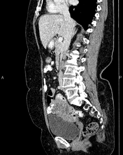 Bilateral ovarian serous cystadenocarcinoma (Radiopaedia 86062-101989 E 36).jpg