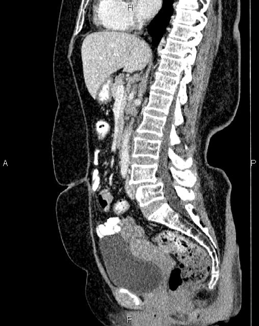 Bilateral ovarian serous cystadenocarcinoma (Radiopaedia 86062-101989 E 41).jpg