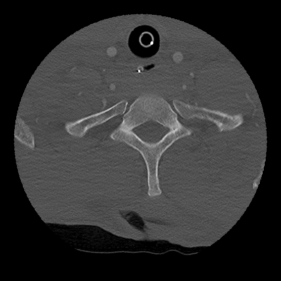 File:Bilateral perched facets with cord injury (Radiopaedia 45587-49713 Axial bone window 93).jpg