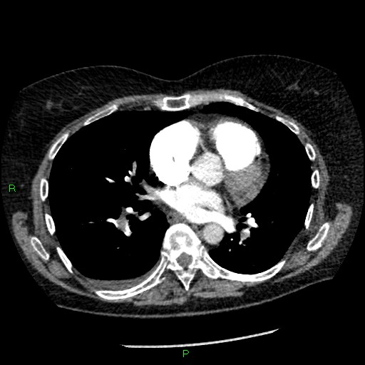 Bilateral pulmonary emboli (Radiopaedia 32700-33669 Axial C+ CTPA 61).jpg