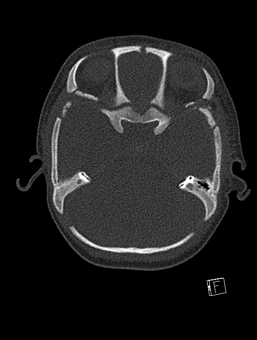 Bilateral subdural hemorrhage and parietal skull fracture (Radiopaedia 26058-26192 Axial bone window 98).png