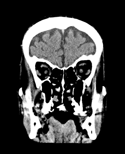 Bilateral subdural hygroma (Radiopaedia 73637-84421 Coronal non-contrast 10).jpg