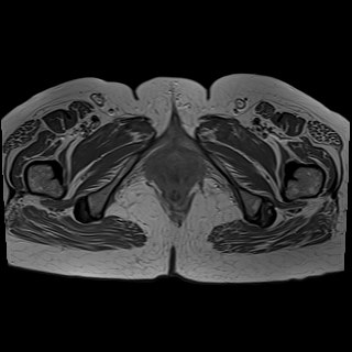 Bilateral tubo-ovarian abscesses (Radiopaedia 58635-65829 Axial T1 C+ 49).jpg