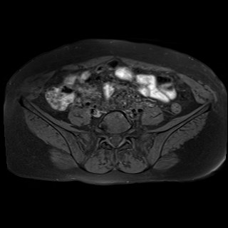 Bilateral tubo-ovarian abscesses (Radiopaedia 58635-65829 Axial T1 fat sat 2).jpg