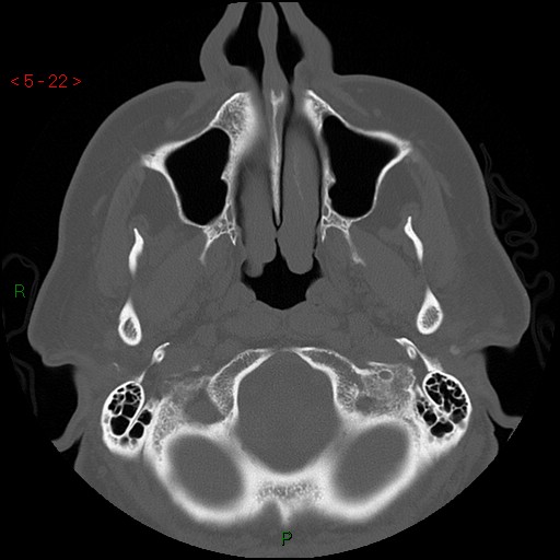 Bisphosphonate-related osteonecrosis of the jaw (Radiopaedia 54147-60329 Axial bone window 16).jpg