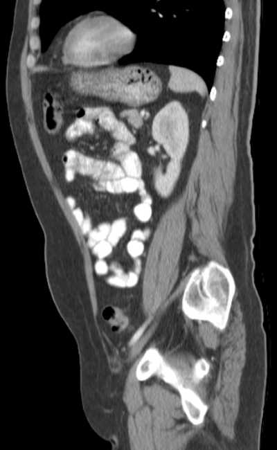 Bleeding duodenal ulcer and adenomyomatosis of gallbladder (Radiopaedia 61834-69861 C 69).jpg