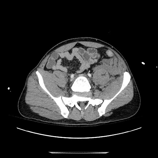 Blunt abdominal trauma with solid organ and musculoskelatal injury with active extravasation (Radiopaedia 68364-77895 A 114).jpg