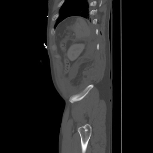 Blunt abdominal trauma with solid organ and musculoskelatal injury with active extravasation (Radiopaedia 68364-77895 Sagittal bone window 97).jpg