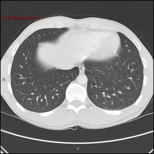 Blunt chest trauma - pulmonary interstitial emphysema and pneumomediastinum (Radiopaedia 20666-20552 Axial lung window 48).jpg