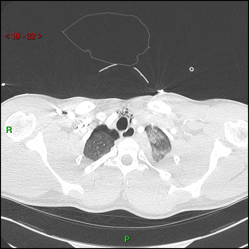 Blunt thoracic trauma (Radiopaedia 73454-84221 Axial lung window 12).jpg
