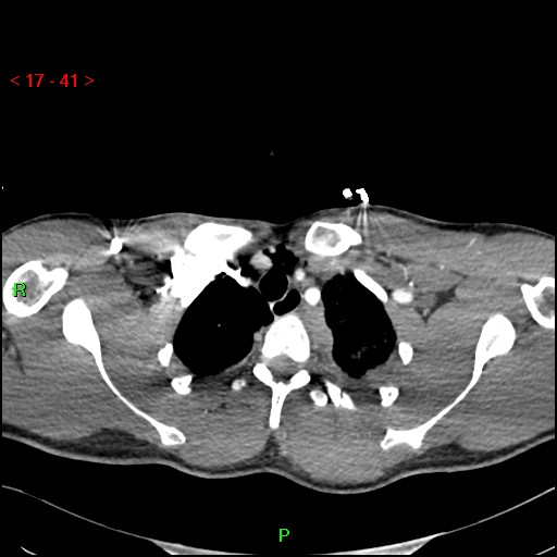 Blunt thoracic trauma (Radiopaedia 73454-84221 Axial soft tissues 15).jpg