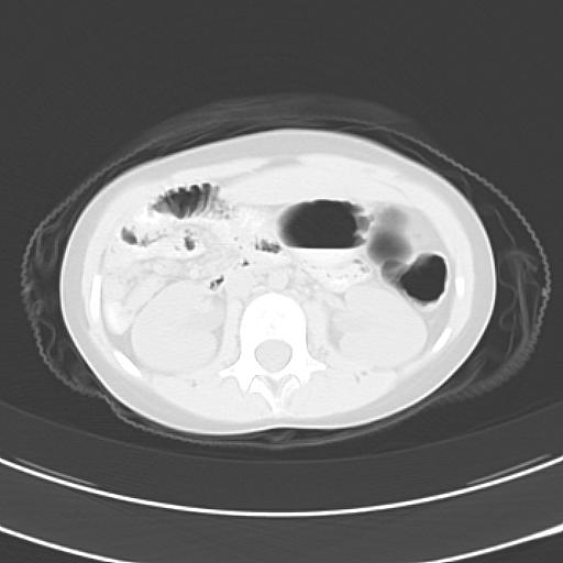 File:Bochdalek diaphragmatic hernia (Radiopaedia 38866-41059 Axial lung window 30).jpg