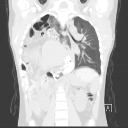 File:Bochdalek diaphragmatic hernia (Radiopaedia 38866-41059 Coronal lung window 13).jpg