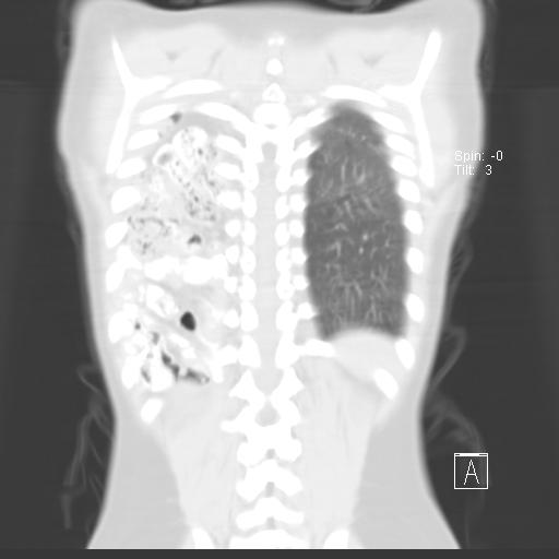 File:Bochdalek diaphragmatic hernia (Radiopaedia 38866-41059 Coronal lung window 18).jpg
