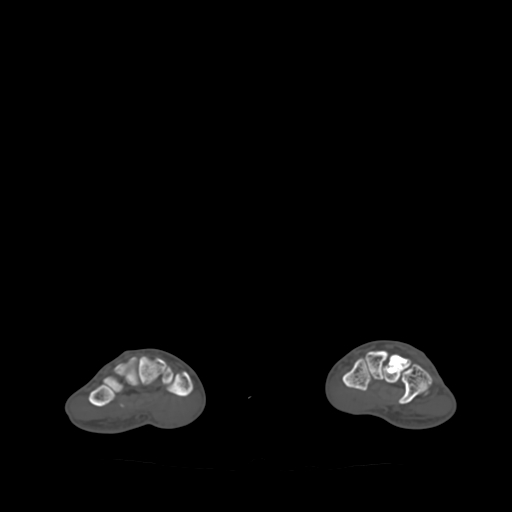 Bone islands - carpus (Radiopaedia 63141-71658 Axial bone window 29).jpg