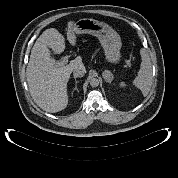 Bosniak renal cyst - type IV (Radiopaedia 24244-24518 Axial non-contrast 113).jpg