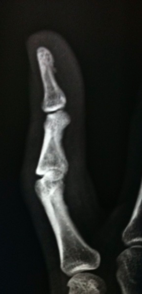 File:Boutonniere deformity - grade 4 (Radiopaedia 12930-13036 Lateral 1).png