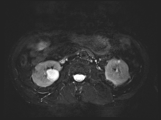 File:Bouveret syndrome (Radiopaedia 61017-68856 Axial MRCP 38).jpg
